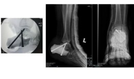 马来西亚肿瘤学家用3D打印模具进行了该国第一次脚跟骨置换
